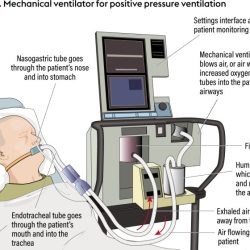 Nursing care advanced airways and mechanical ventilation edapt