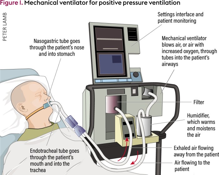 Nursing care advanced airways and mechanical ventilation edapt